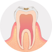 歯の表面に虫歯ができます