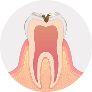 虫歯が神経に近くなり、冷たいものがしみます