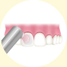 歯の表面をツルツルに仕上げ磨き